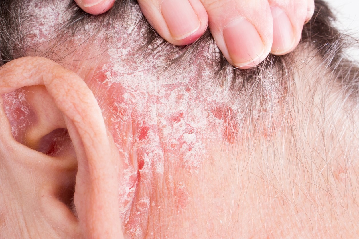 Costras en el cuero cabelludo, ¿por qué sale la dermatitis seborreica y cómo se elimina?