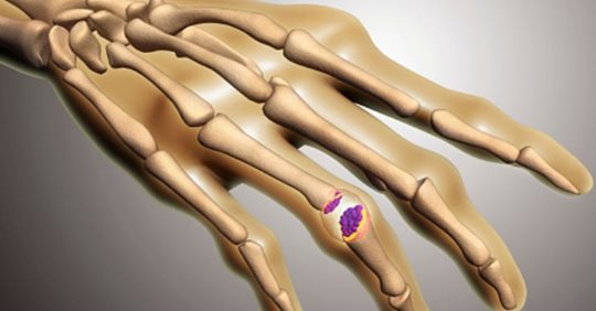 ¿Qué es la osteoartrosis y quienes son los mas propensos a padecerla ?