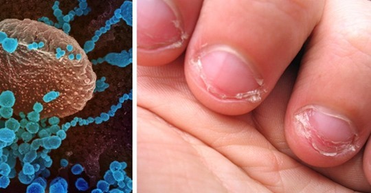 Comerse las uñas puede aumentar el riesgo de contraer el Coronavirus: advierten los expertos