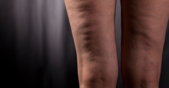 Remedios naturales para eliminar la flacidez Remedios naturales para eliminar la flacidez