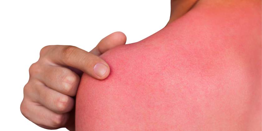 Dra. Montserrat Arita: «Al momento de quemarse la piel en casa, se deben de tomar las siguientes consideraciones» Dra. Montserrat Arita: «Al momento de quemarse la piel en casa, se deben de tomar las siguientes consideraciones»