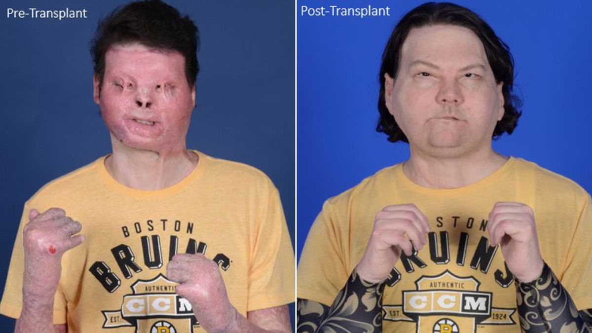 Un hombre de 22 años recibe el primer trasplante de cara y manos de forma exitosa Un hombre de 22 años recibe el primer trasplante de cara y manos de forma exitosa