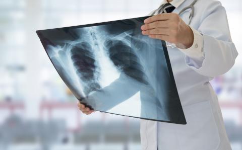 Secretaría de Salud: 31% bajará la tuberculosis en el país este año Secretaría de Salud: 31% bajará la tuberculosis en el país este año