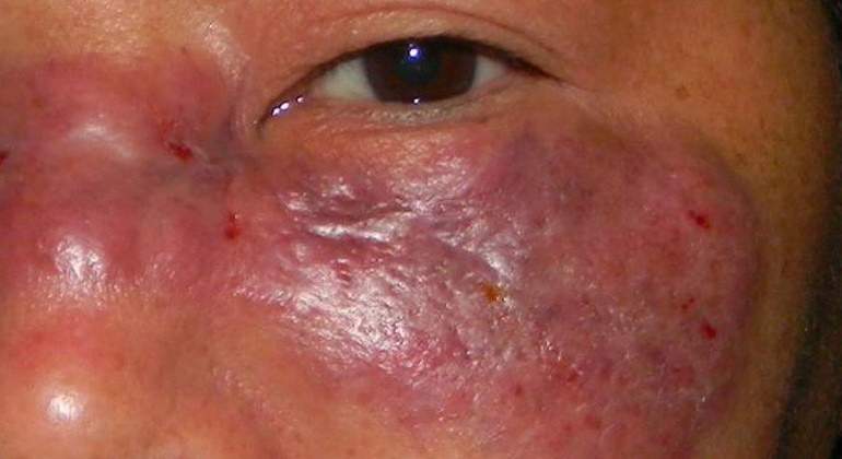 El “hongo negro” se convierte en la nueva amenaza para la humanidad