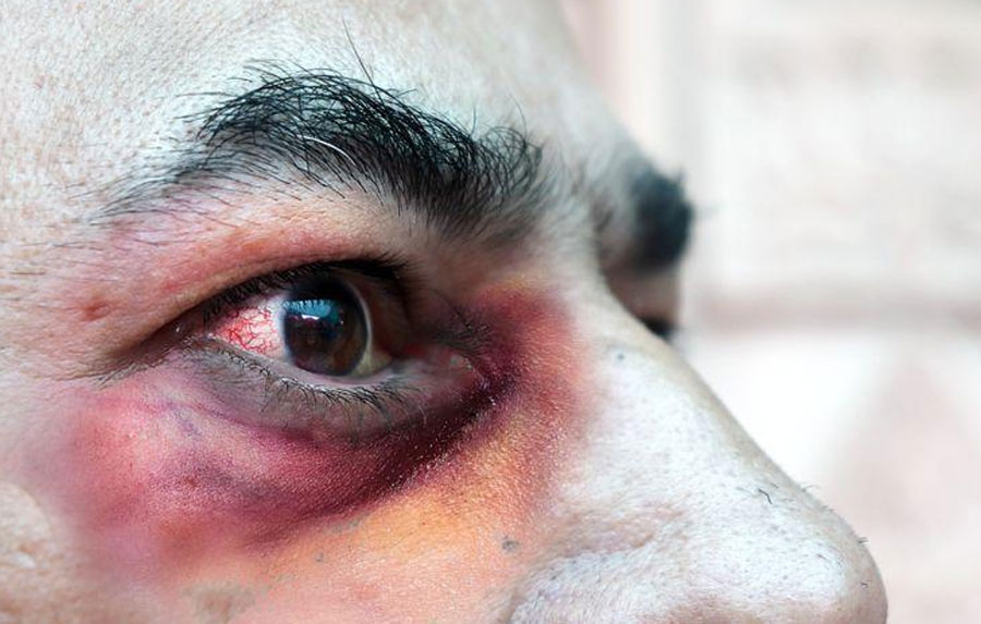 Decano de Medicina: «No deberíamos alarmarnos por el hongo negro”