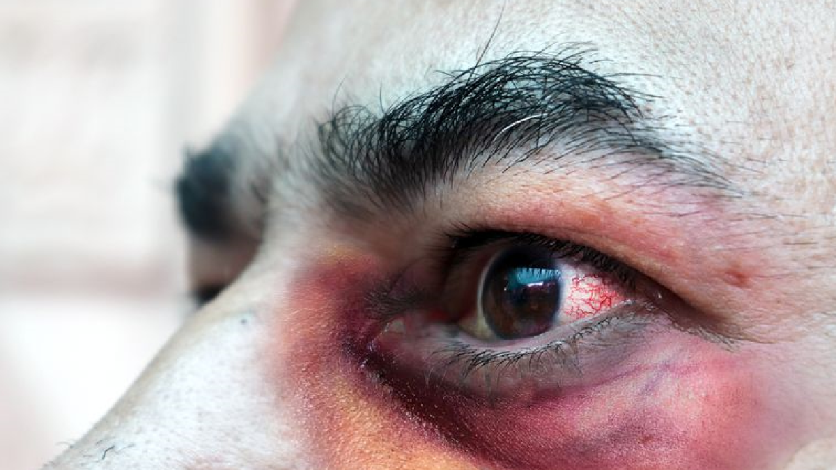 Autoridades sanitarias confirman primer caso de hongo negro en el país