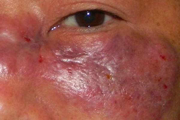 Muere otro paciente sospechoso de Hongo Negro en el hospital de Choluteca Muere otro paciente sospechoso de Hongo Negro en el hospital de Choluteca