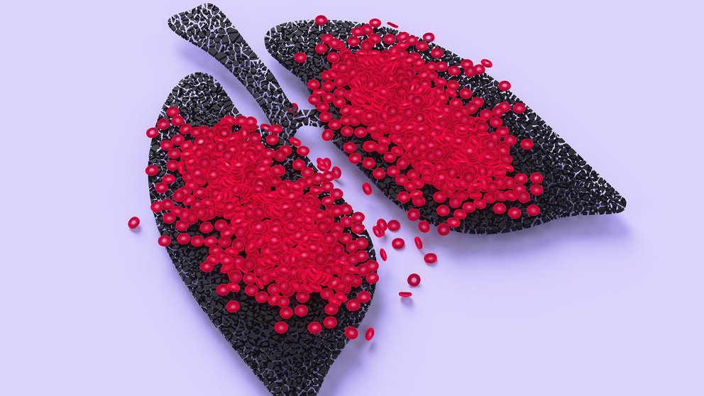 Ponerse en movimiento, el primer paso para evitar la trombosis Ponerse en movimiento, el primer paso para evitar la trombosis