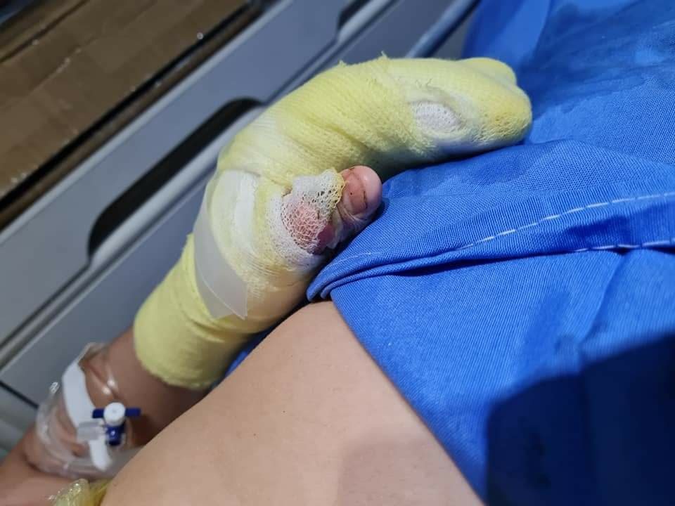 Hombre con quemaduras de tercer grado por pólvora ingresa al Hospital Escuela Hombre con quemaduras de tercer grado por pólvora ingresa al Hospital Escuela