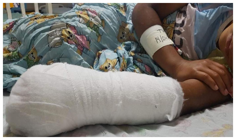 Menor de 6 años se convierte en la tercera víctima por quemaduras de pólvora