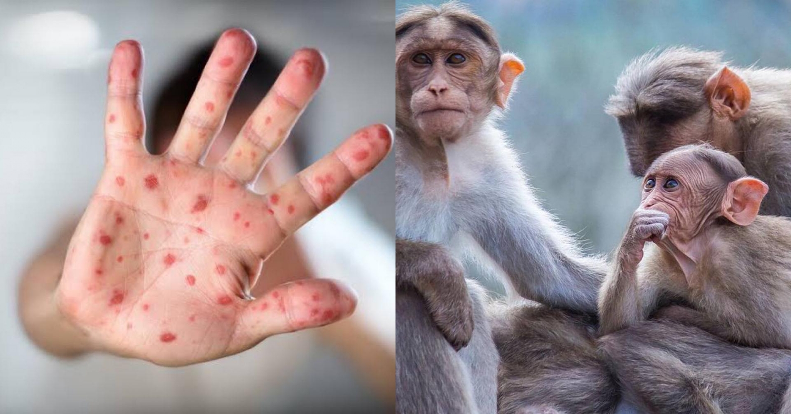 Suben a 21 los casos de viruela del mono en Estados Unidos