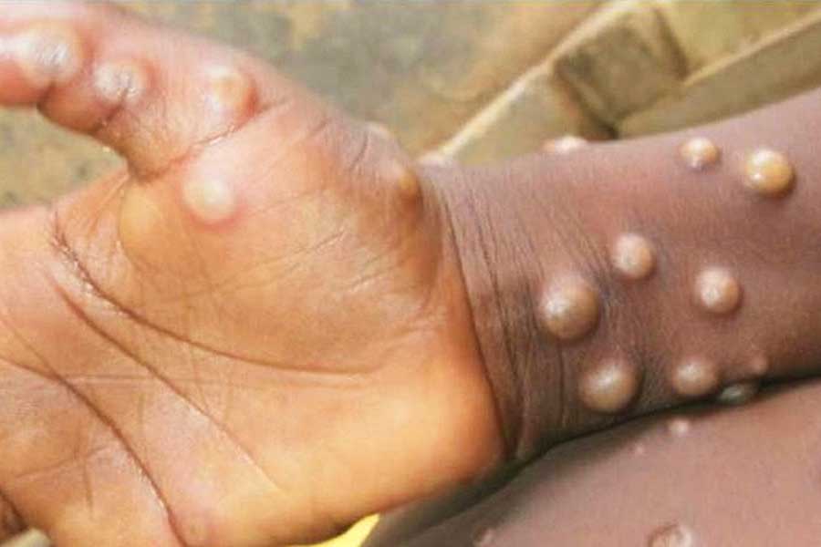 Venezuela reporta su primer caso de viruela del mono