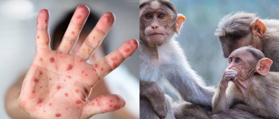 El Salvador confirma primer caso de viruela del mono