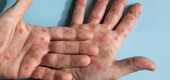 Texas registra la primera muerte en Estados Unidos por viruela del mono