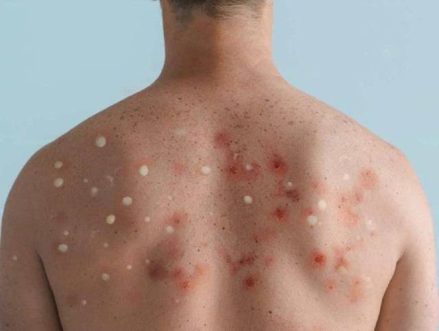 Secretaría de Salud confirma cuarto caso de viruela del mono en Honduras Secretaría de Salud confirma cuarto caso de viruela del mono en Honduras