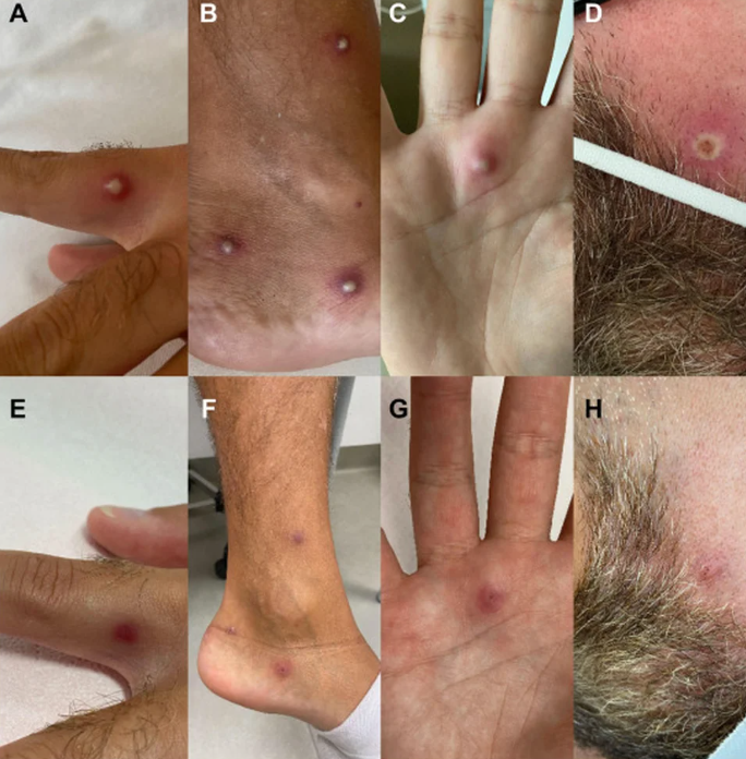 Un hombre da positivo en covid-19, viruela del mono y VIH al mismo tiempo después de regresar de un viaje