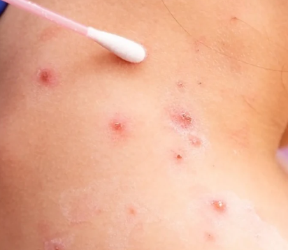 América Latina registra el mayor número de casos de viruela del mono según la OMS