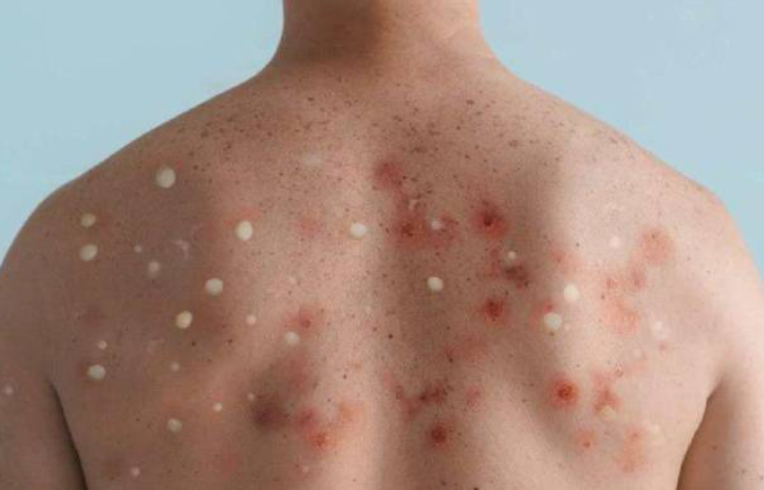 Autoridades de la Secretaría de Salud confirman dos nuevos casos de viruela del mono