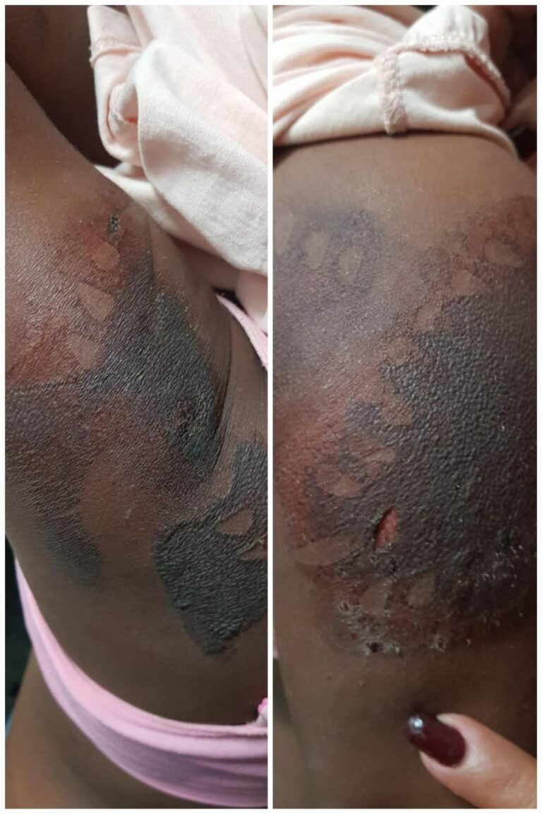 Prisión preventiva para madre que quemó a su hija con una plancha