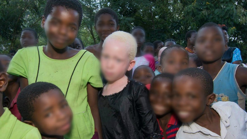 Una misteriosa ola de secuestros de personas albinas preocupa a Madagascar Una misteriosa ola de secuestros de personas albinas preocupa a Madagascar