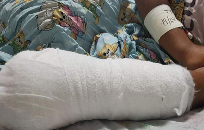 Tres dedos pierde joven al explotar mortero en SPS