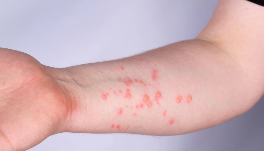 Al menos 19 casos de viruela símica se registran en Honduras Al menos 19 casos de viruela símica se registran en Honduras