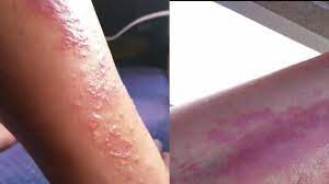 Expertos advierten que bacteria «come carne» se está proliferando en EEUU debido al calentamiento global Expertos advierten que bacteria «come carne» se está proliferando en EEUU debido al calentamiento global